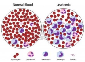 leukemia (1)